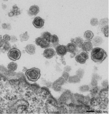 만성피로증후군 환자의 세포와 함께 배양한 전립선암세포(LNCaP cells)에서 바이러스(XMRV) 입자가 나오는 장면을 포착한 전자현미경 사진으로 2009년 논문에 실렸다. 훗날 조사한 결과 시약이 바이러스에 오염된 것으로 결론이 나 논문이 철회됐다. - 사이언스 제공