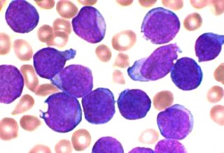 급성 림프구성 백혈병(ALL)을 앓는 환자에게서 추출한 면역세포 전구체(보라색) - 위키피디아 제공