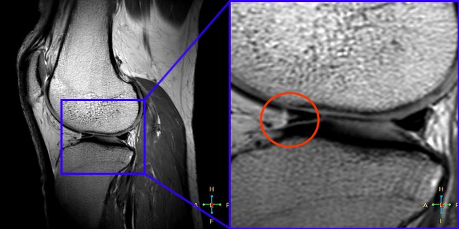 취재 기자의 왼쪽 무릎을 7T(테슬라)자기공명영상(MRI) 장비로 촬영했다(왼쪽), 확대해 보면 인대 부위에 부상 흔적이 남아 있는 것이 또렷이 보인다(오른쪽). - 한국기초과학지원연구원 제공