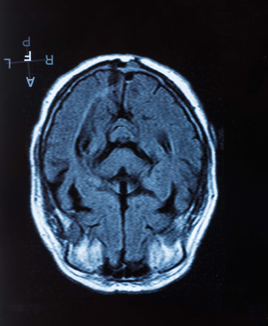 MRI 촬영을 한 인간 뇌의 모습이다. 대뇌반구의 표면에 있는 얇고 주름잡힌 회백질층이 대뇌피질이다. -게티이미지뱅크 