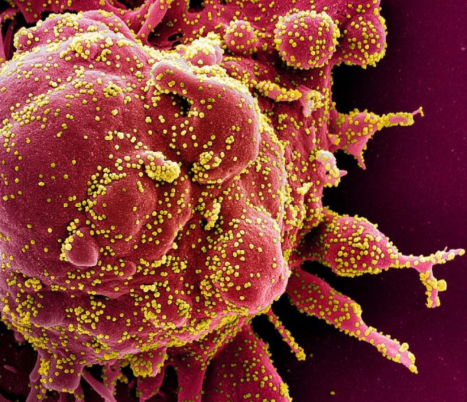 코로나19를 일으키는 사스코로나바이러스-2(노란색)에 심하게 감염돼 사멸에 이르고 있는 세포(붉은색)의 전자현미경 사진이다. NIAID 제공
