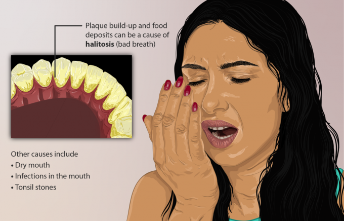 코로나19로 마스크 착용이 일상화되면서 입 냄새로 고민하는 사람들이 늘고 있다. 입 냄새의 90%는 혀나 치아, 잇몸에 존재하는 막인 플라크(바이오필름)에 거주하는 구강미생물이 먹이(음식물 찌꺼기나 죽은 세포)를 대사하는 과정에서 나오는 휘발성 분자 때문이다. 위키피디아 제공