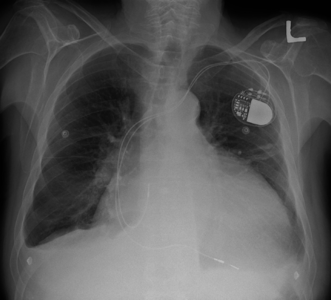 심장비대증 환자의 가슴을 엑스레이(X-ray)로 촬영했다. 오른쪽 상단의 기기는 부정맥 치료에 사용되는 심박조율기다. 위키피디아 제공