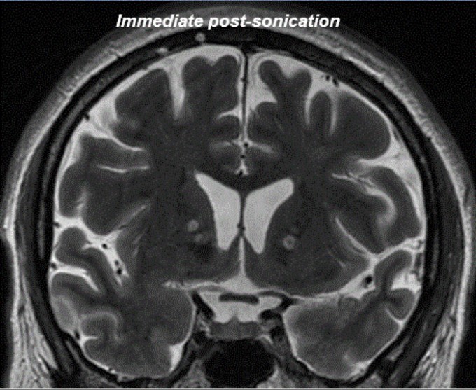 치료 저항성 우울증 환자의 뇌를 자기공명영상(MRI)로 촬영했다. 연세대 세브란스병원 제공