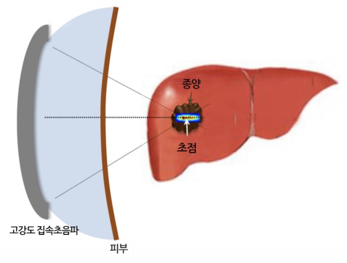 집속 초음파로 종양 조직을 괴사시키는 개념도. KIST 제공.