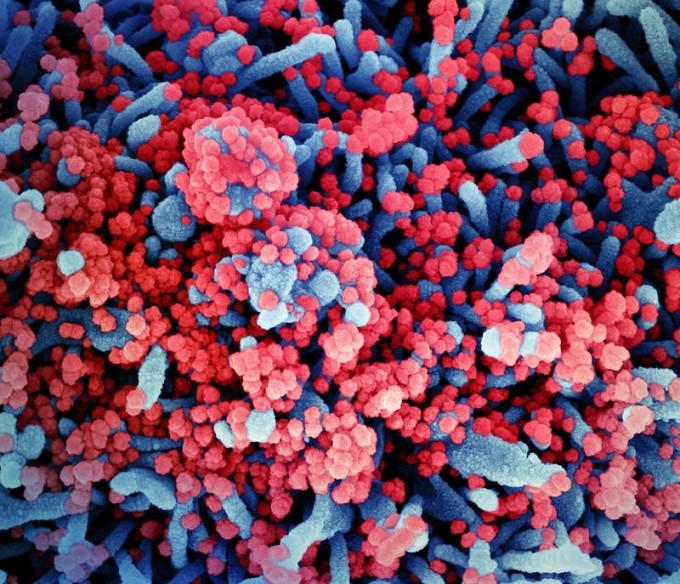 신종 코로나 바이러스 감염 (COVID-19, 코로나 19) 환자의 검체에서 채취 한 환자의 세포 (파란색)을 관찰 한 전자 현미경 사진이다. 사스 코로나 바이러스 -2 (SARS-CoV-2, 빨강)이 세포 표면을 가득 덮고있다. NIAID 제공