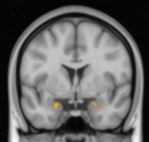 스웨덴 린코핑대 연구팀이 불안장애를 앓고 있는 환자들에게 인지치료를 진행한 결과, 뇌 편도체(사진에서 노란부분)의 부피가 줄고, 활성도 진정됐다. 노란색에 가까울수록 뇌의 산소포화도가 높아 뇌 활성이 활발하다는 뜻이다. 중개정신의학 제공