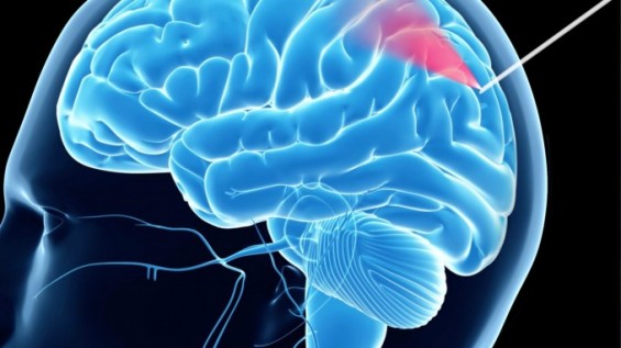 뇌출혈 없는 안전한 뇌 조직검사용 바늘 개발