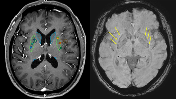이식 전(왼쪽)후(오른쪽) MRI, 이식 후 MRI에서 성공적으로 세포가 이식된 부위를 확인할 수 있다(화살표). 세브란스병원 제공