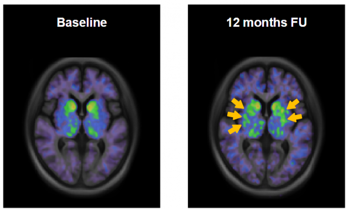 도파민 신경세포 이식 후 생착을 시사하는 고용량 투여군의 뇌 영상(FP-CIT-PET) 사진. 이식 전(Baseline) 대비 12개월 후 영상 신호가 증가한 것을 확인할 수 있다. 연세대 의대 제공.