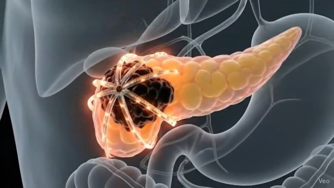 췌장을 감싸고 빛을 조사하는 3차원 마이크로 발광다이오드(LED) 장치가 작동하는 모습. KAIST 제공