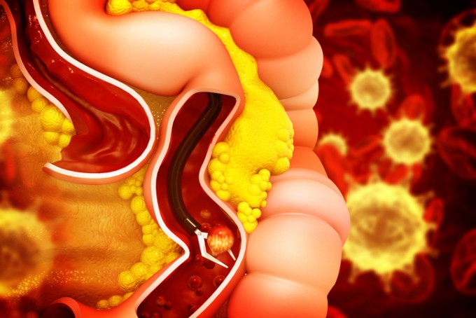 A team led by Professor Park Jihwan at GIST has developed a technology to precisely predict the response to immuno-oncology therapy by analyzing the differences in immune response of individual cancer cells composing a tumor at the cellular level. Image of colorectal cancer. Provided by Getty Images Bank 