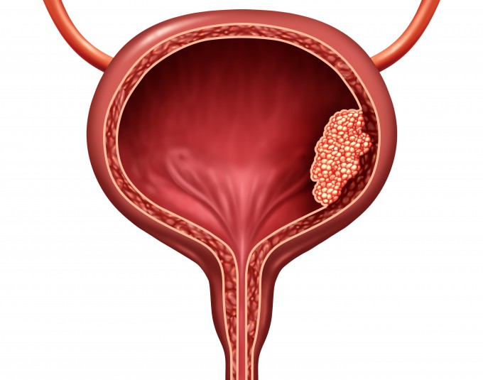 semaglutide and bladder cancer Saxenda Side Effects: Does It Cause Cancer?  Bolt Pharmacy Benefits of Semaglutide GLP-1 |